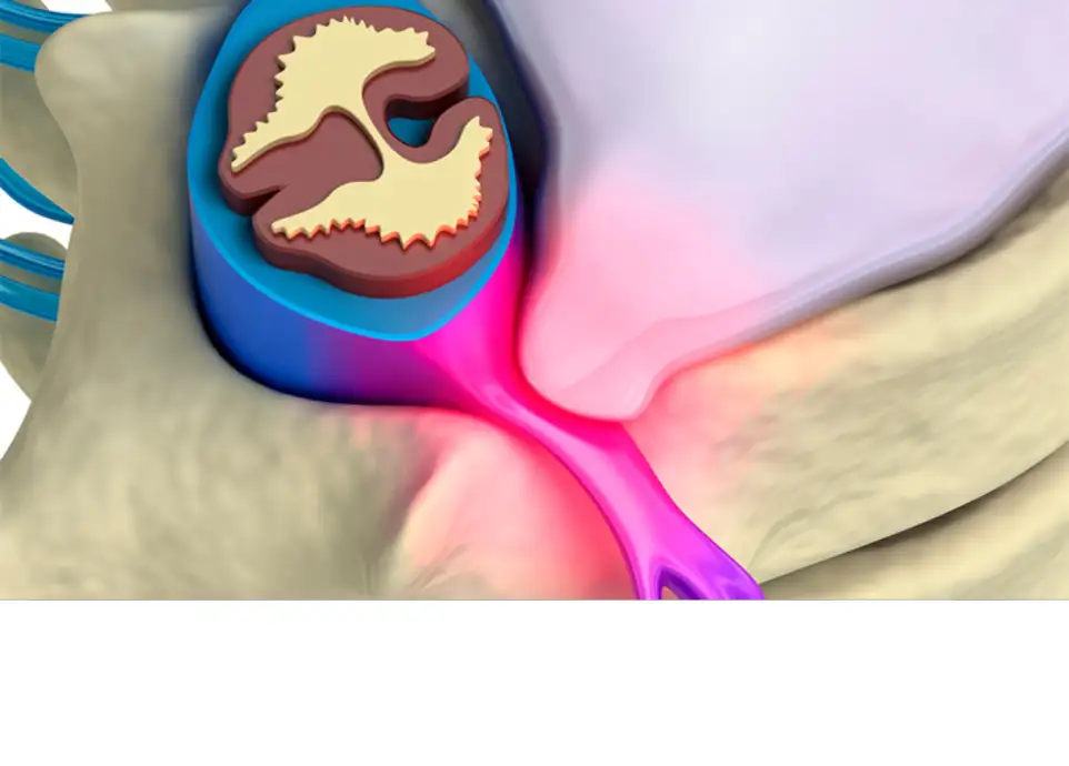 Triton DTS spinal decompression system at DakshinRehab Moosapet clinic